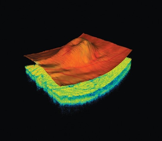 Ocular Coherence Tomography